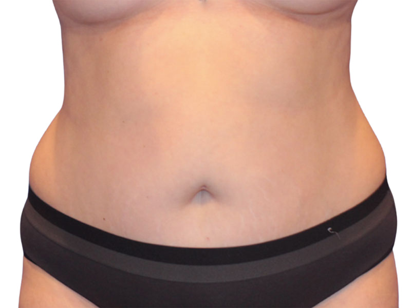 Liposuction Before and After | PERK Plastic Surgery