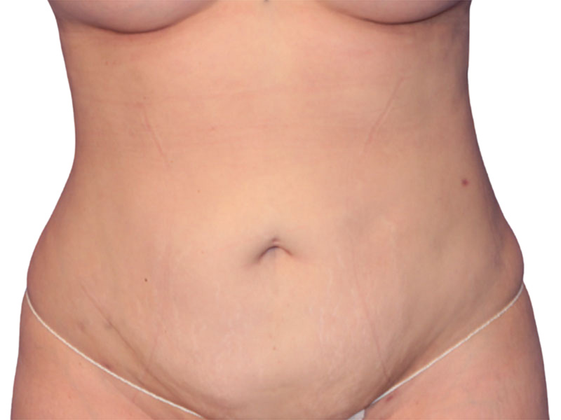 Liposuction Before and After | PERK Plastic Surgery