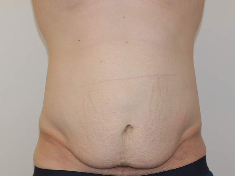 Tummy Tuck Before and After | PERK Plastic Surgery