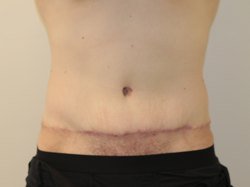 Tummy Tuck Before and After | PERK Plastic Surgery
