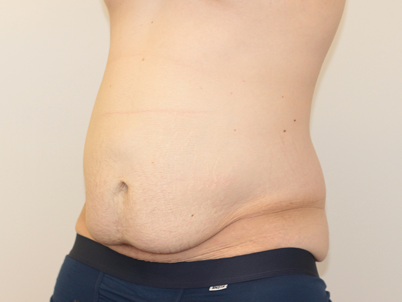 Tummy Tuck Before and After | PERK Plastic Surgery