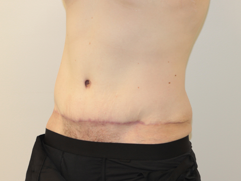 Tummy Tuck Before and After | PERK Plastic Surgery