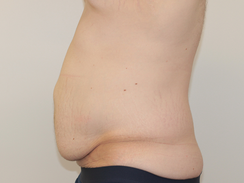 Tummy Tuck Before and After | PERK Plastic Surgery