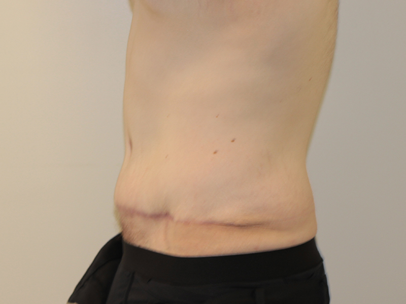 Tummy Tuck Before and After | PERK Plastic Surgery
