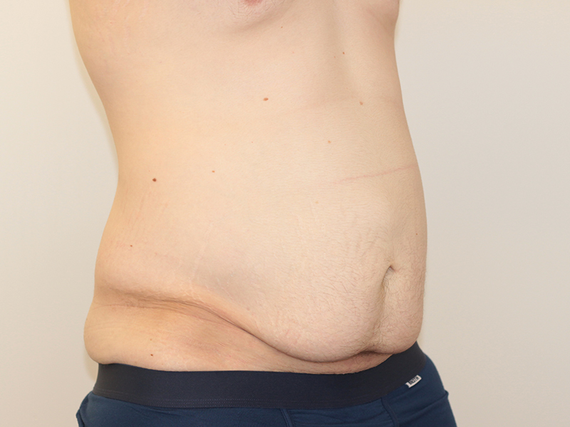 Tummy Tuck Before and After | PERK Plastic Surgery
