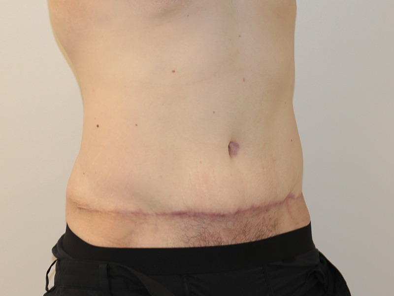 Tummy Tuck Before and After | PERK Plastic Surgery