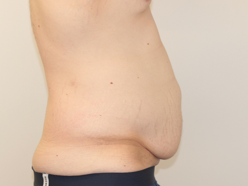 Tummy Tuck Before and After | PERK Plastic Surgery