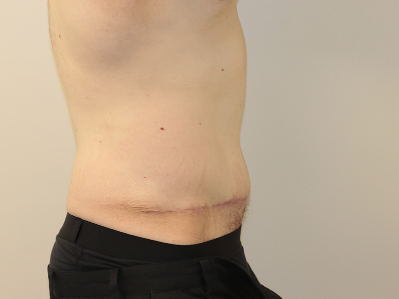 Tummy Tuck Before and After | PERK Plastic Surgery