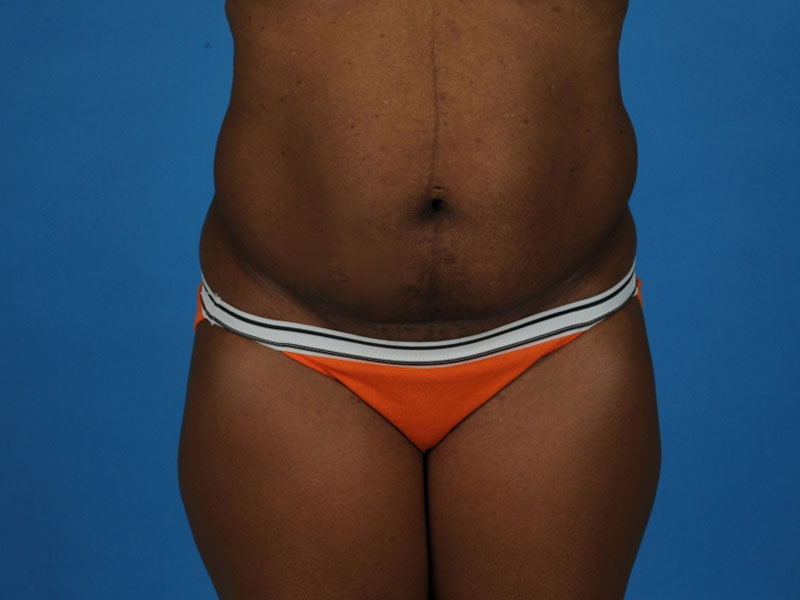Tummy Tuck Before and After | PERK Plastic Surgery