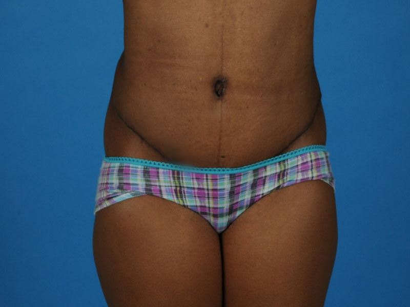 Tummy Tuck Before and After | PERK Plastic Surgery