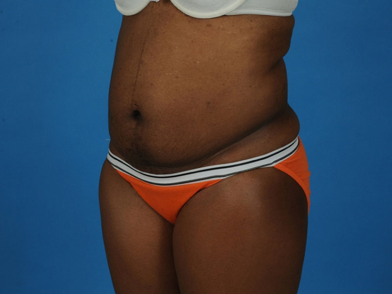 Tummy Tuck Before and After | PERK Plastic Surgery