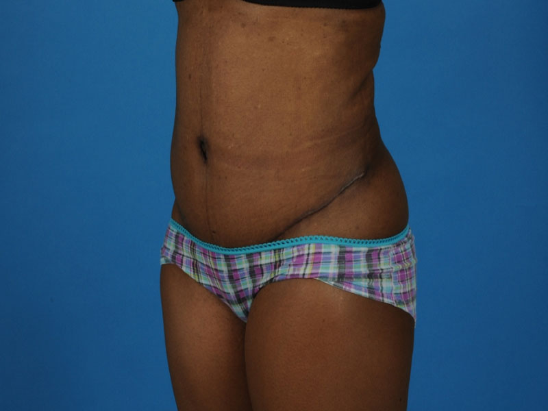 Tummy Tuck Before and After | PERK Plastic Surgery