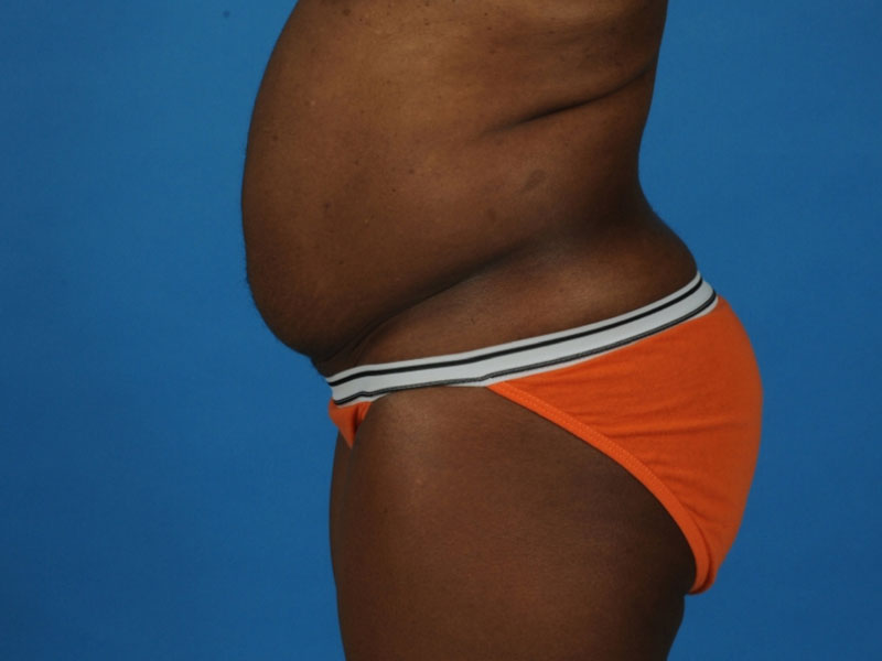Tummy Tuck Before and After | PERK Plastic Surgery
