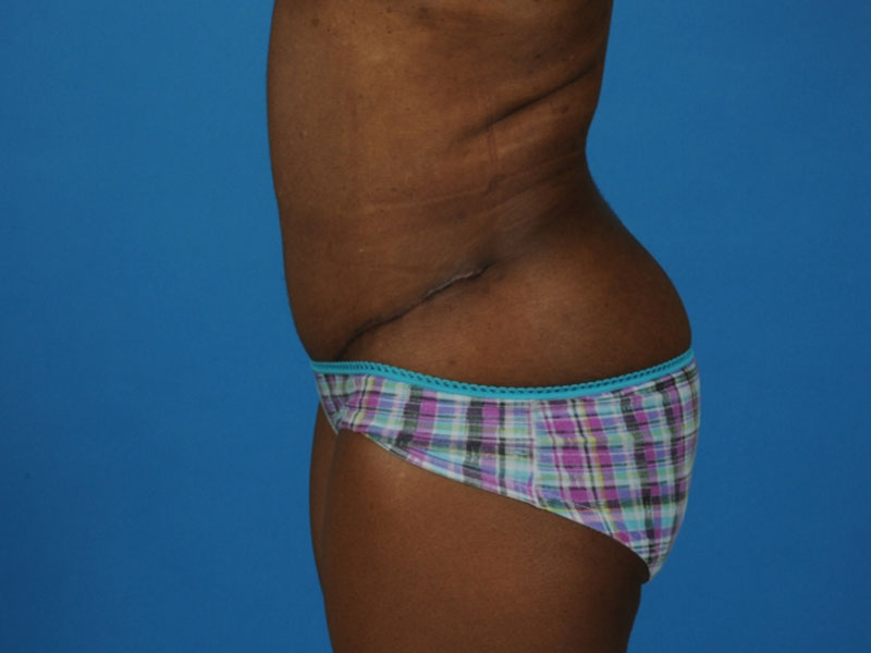 Tummy Tuck Before and After | PERK Plastic Surgery