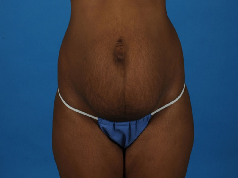 Tummy Tuck Before and After | PERK Plastic Surgery