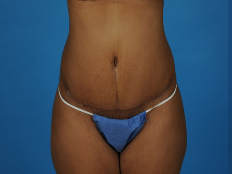 Tummy Tuck Before and After | PERK Plastic Surgery