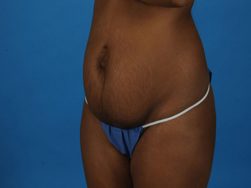 Tummy Tuck Before and After | PERK Plastic Surgery