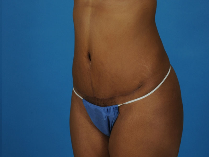 Tummy Tuck Before and After | PERK Plastic Surgery