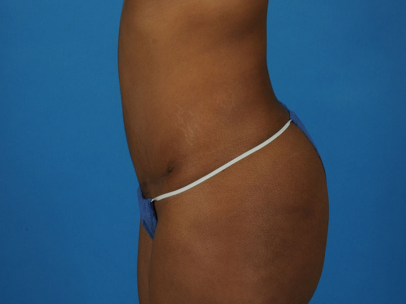 Tummy Tuck Before and After | PERK Plastic Surgery