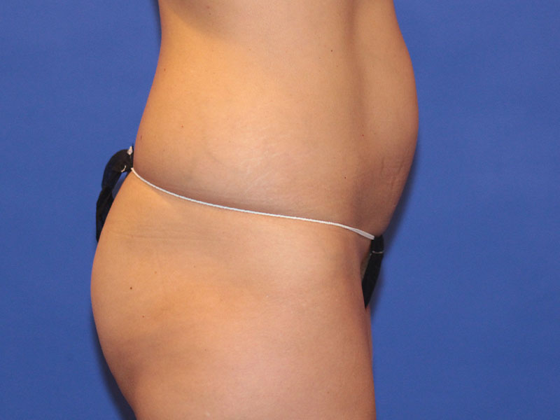 Tummy Tuck Before and After | PERK Plastic Surgery