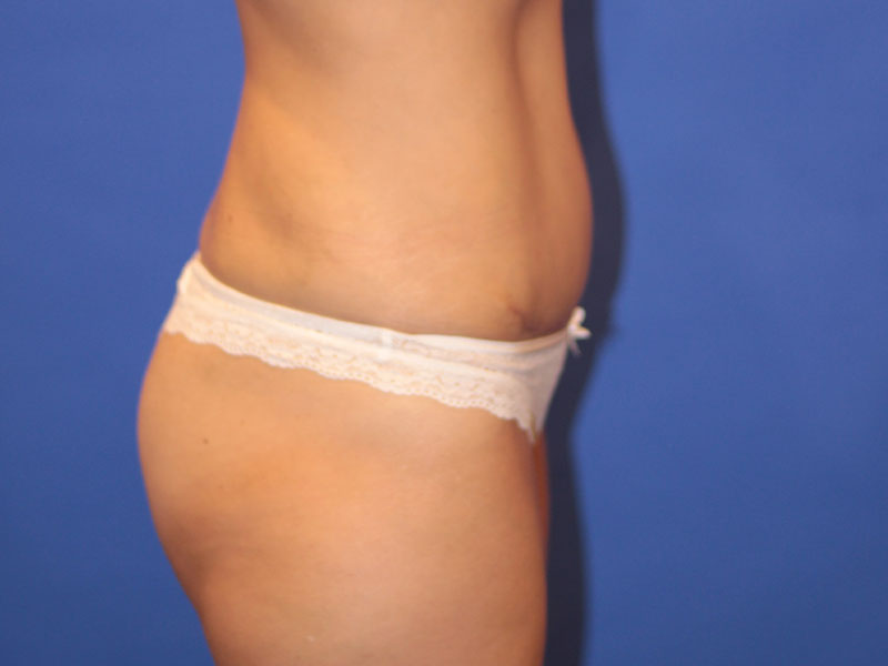 Tummy Tuck Before and After | PERK Plastic Surgery