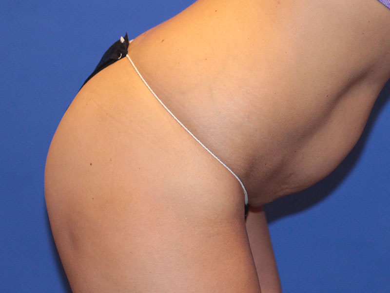 Tummy Tuck Before and After | PERK Plastic Surgery