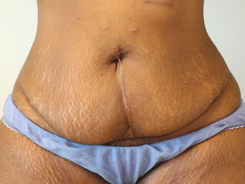 Tummy Tuck Before and After | PERK Plastic Surgery