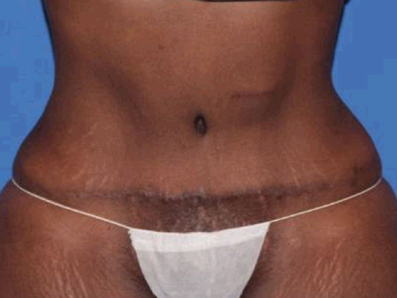 Tummy Tuck Before and After | PERK Plastic Surgery