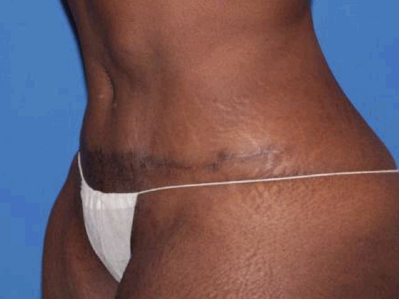 Tummy Tuck Before and After | PERK Plastic Surgery