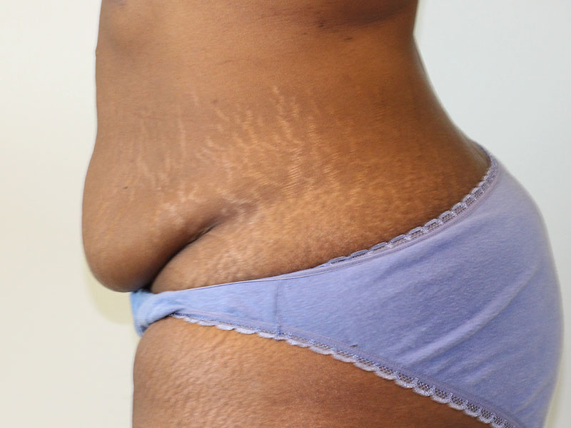 Tummy Tuck Before and After | PERK Plastic Surgery