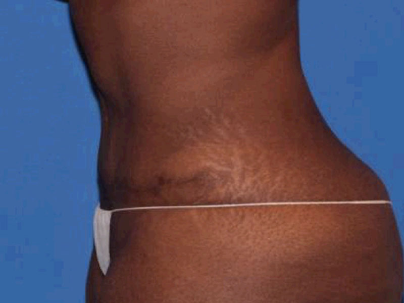 Tummy Tuck Before and After | PERK Plastic Surgery