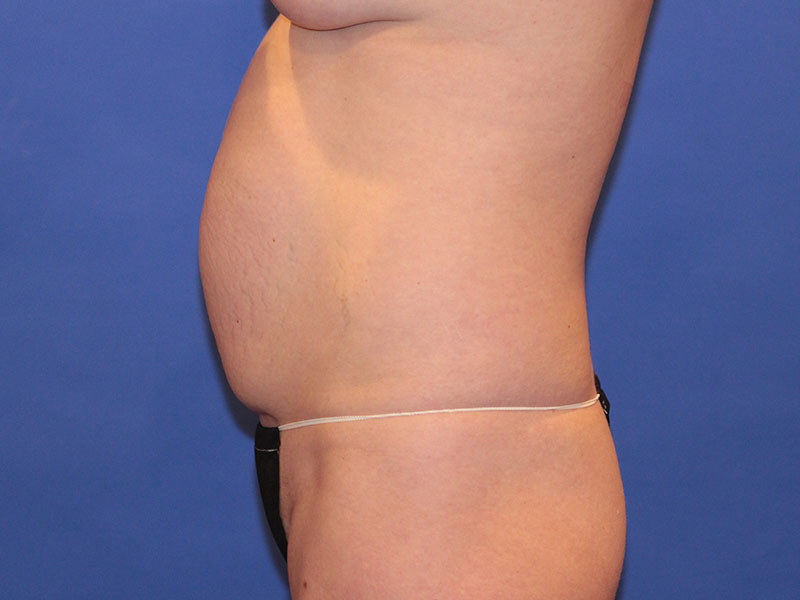 Tummy Tuck Before and After | PERK Plastic Surgery