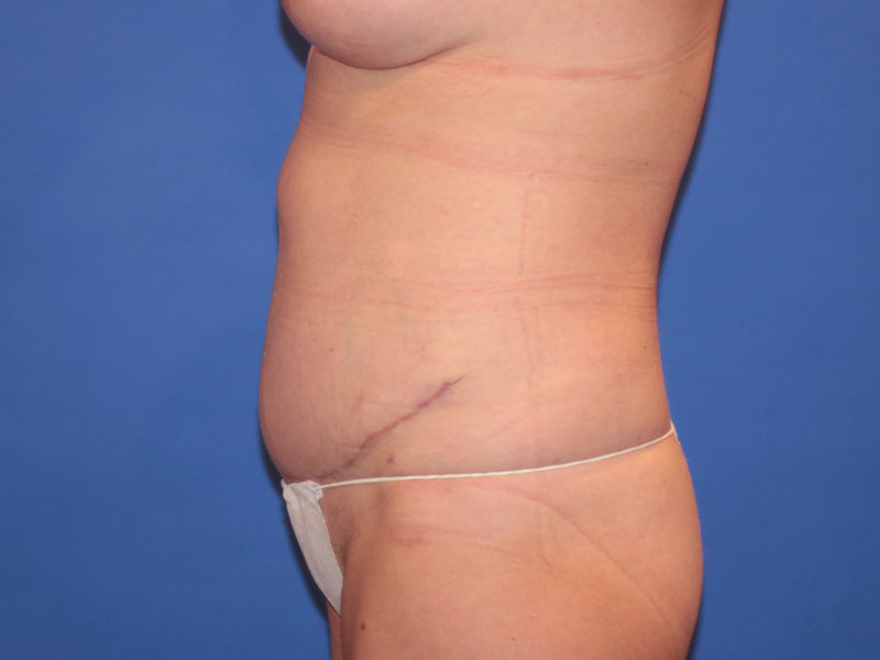 Tummy Tuck Before and After | PERK Plastic Surgery