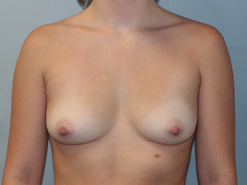 Breast Augmentation Beverly Hills