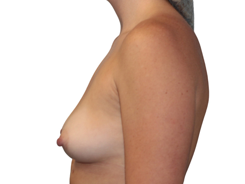 Breast Augmentation Before and After | PERK Plastic Surgery
