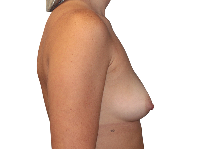 Breast Augmentation Before and After | PERK Plastic Surgery