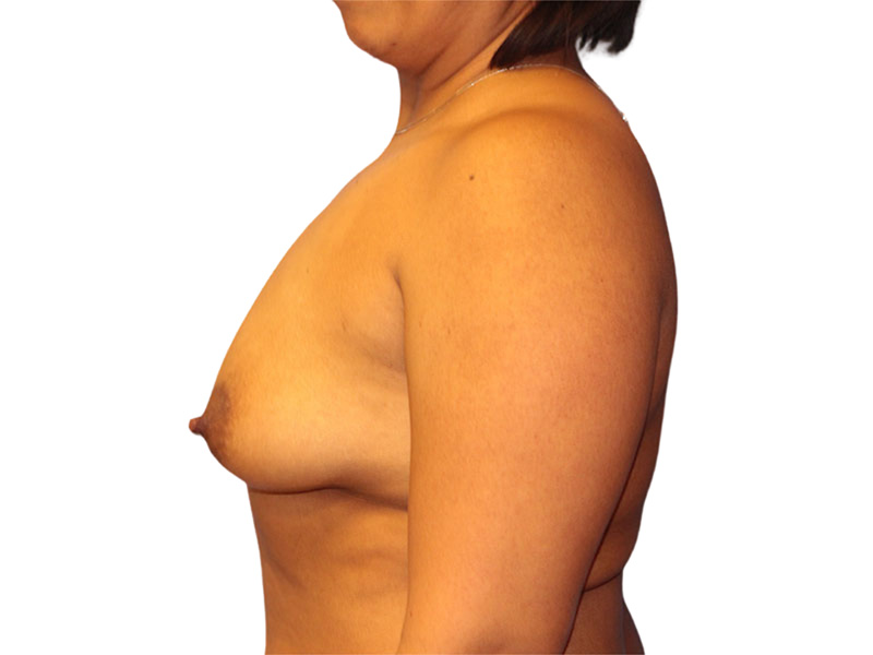 Breast Augmentation Before and After | PERK Plastic Surgery
