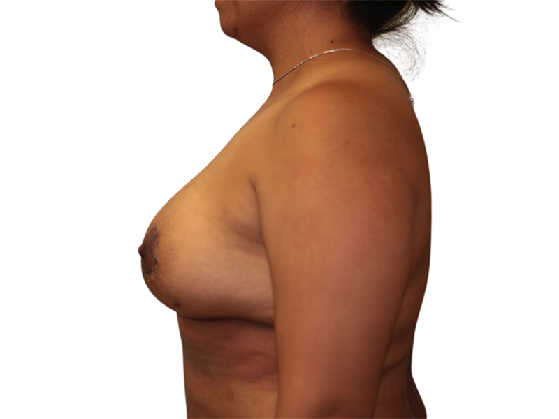 Breast Augmentation Before and After | PERK Plastic Surgery