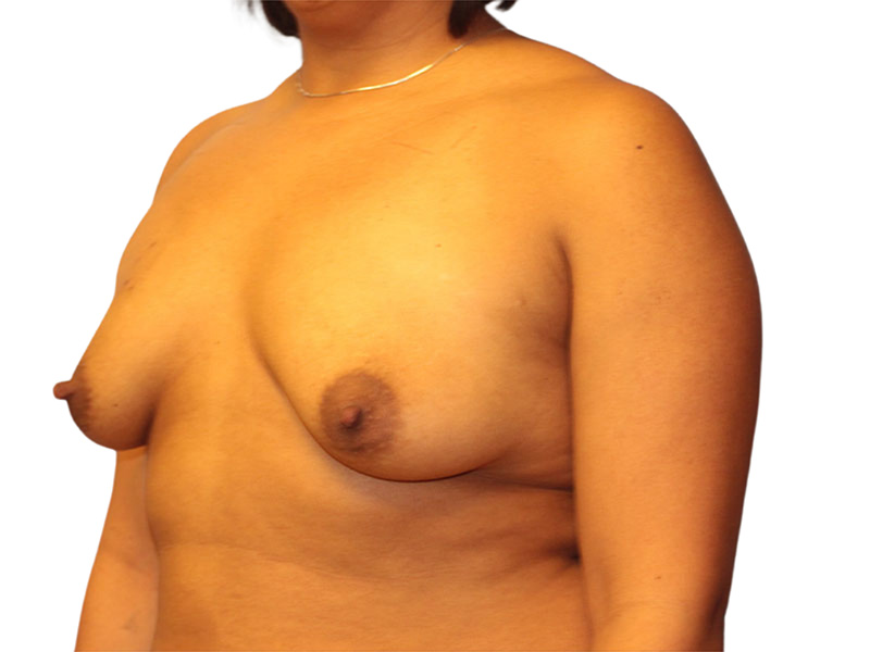 Breast Augmentation Before and After | PERK Plastic Surgery