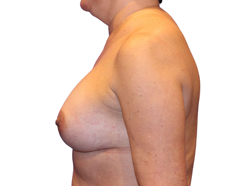 Breast Augmentation Before and After | PERK Plastic Surgery