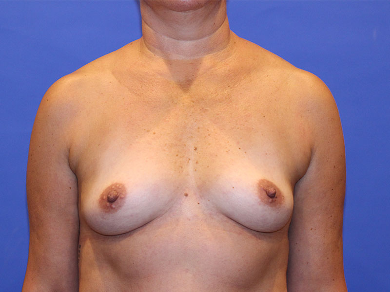 Breast Augmentation Before and After | PERK Plastic Surgery