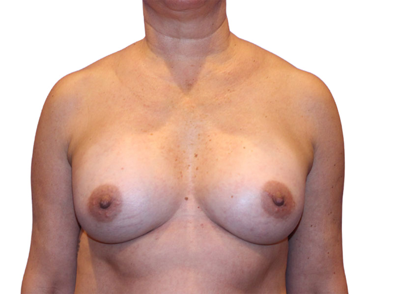 Breast Augmentation Before and After | PERK Plastic Surgery