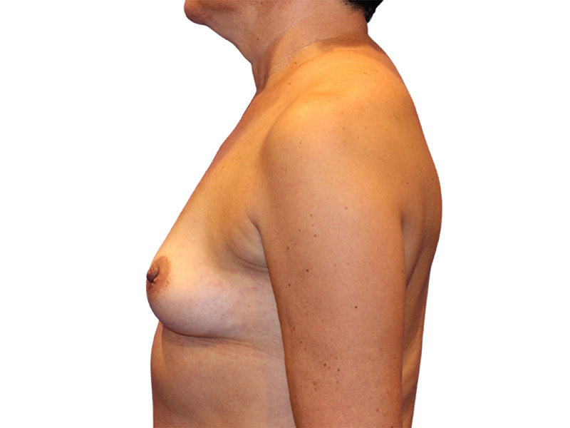 Breast Augmentation Before and After | PERK Plastic Surgery