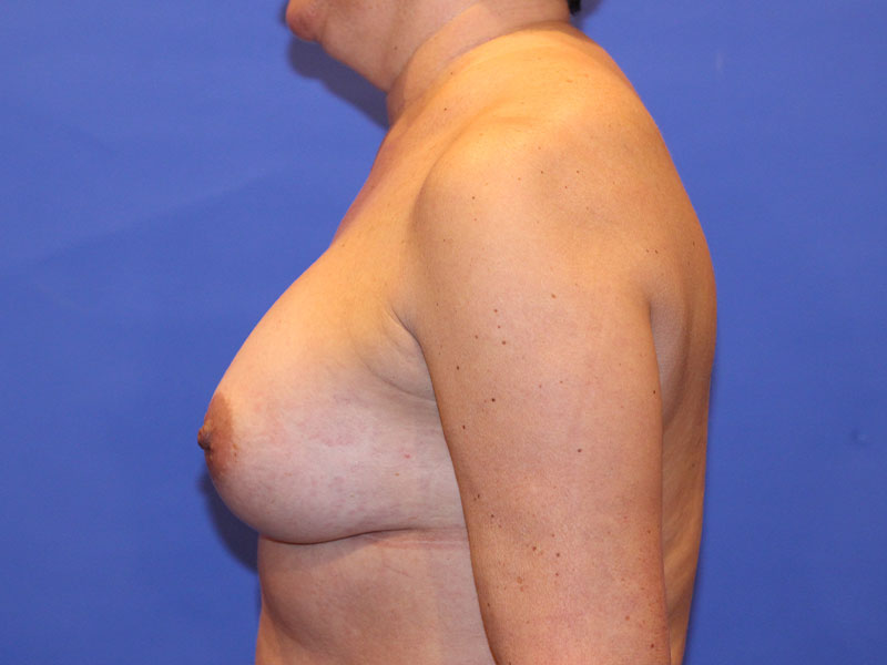 Breast Augmentation Before and After | PERK Plastic Surgery