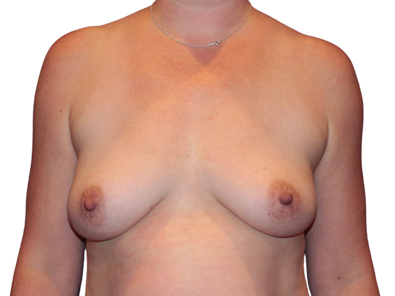 Breast Augmentation Before and After | PERK Plastic Surgery