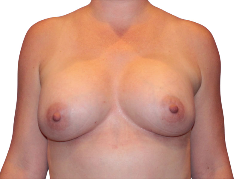 Breast Augmentation Before and After | PERK Plastic Surgery