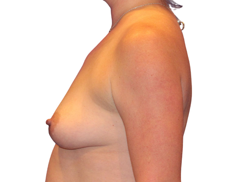 Breast Augmentation Before and After | PERK Plastic Surgery
