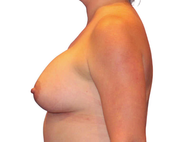 Breast Augmentation Before and After | PERK Plastic Surgery