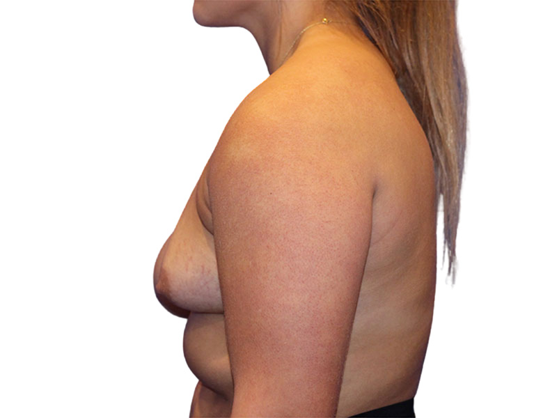 Breast Augmentation Before and After | PERK Plastic Surgery