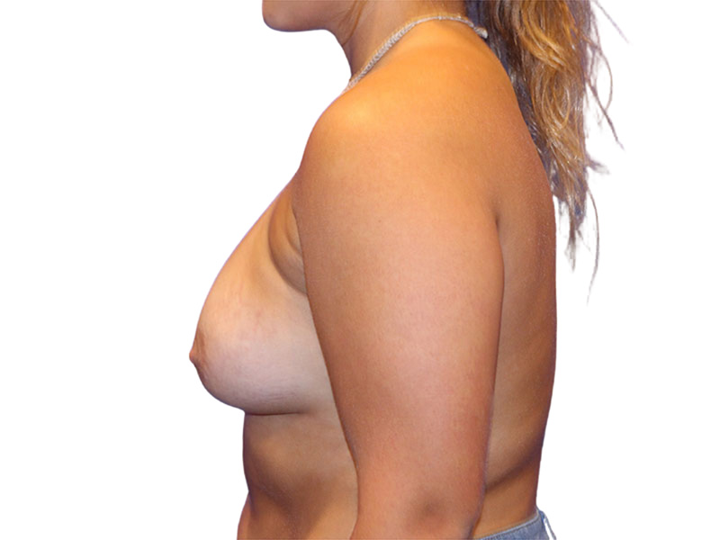 Breast Augmentation Before and After | PERK Plastic Surgery